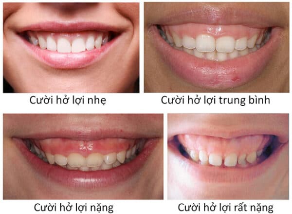 Cười hở lợi là bệnh gì?