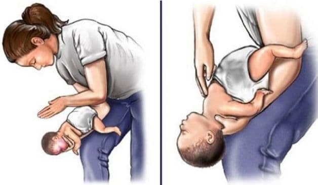 Trẻ sơ sinh có thể xử trí hóc xương bằng thủ thuật vỗ lưng, ấn ngực
