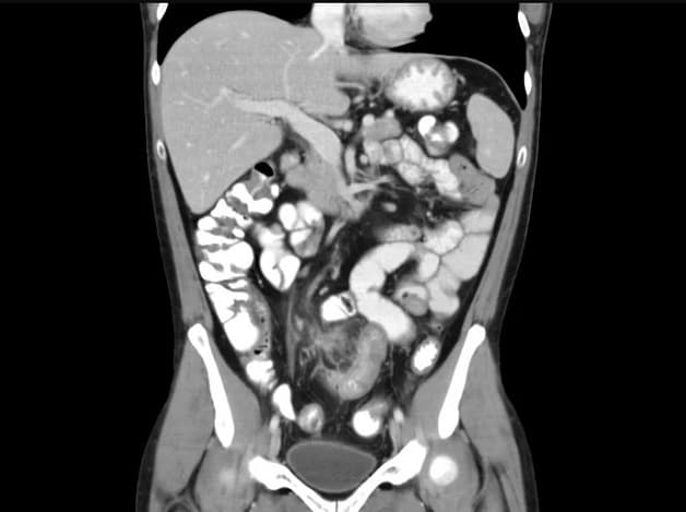 chụp CT ổ bụng