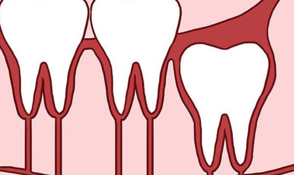 Đa phần răng khôn mọc sẽ khiến người bị cảm thấy đau đớn