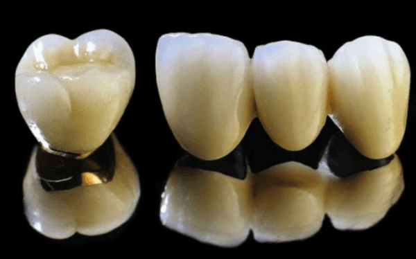 có nên bọc răng sứ kim loại