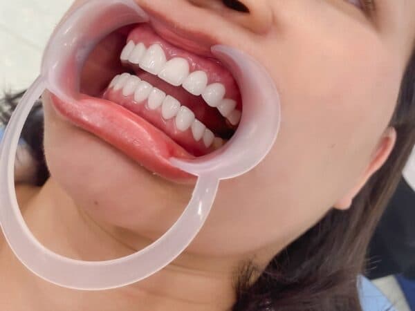 có nên bọc răng sứ kim loại không