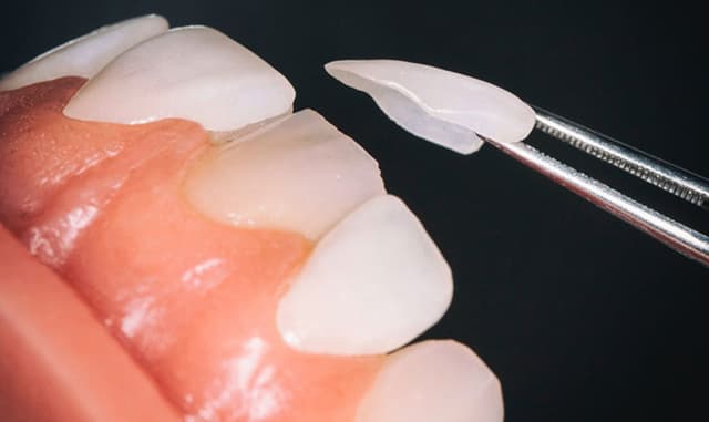 Công nghệ dán sứ Veneer và những điều cần biết