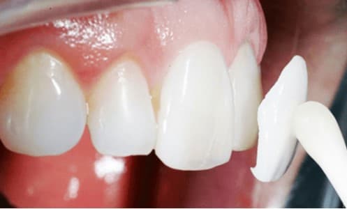 Dán phủ răng có thể khắc phục