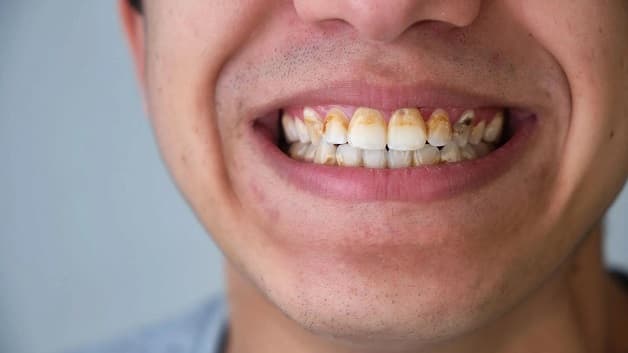 đánh bay cao răng tại nhà để an tâm sức khỏe răng miệng