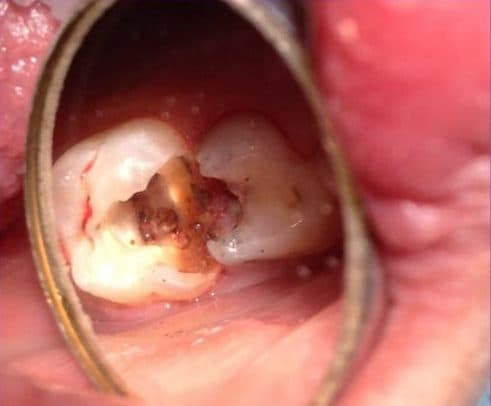 Điều trị tủy bằng thuốc diệt tủy cũng có những ưu điểm