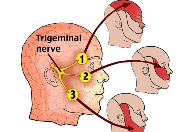 bệnh viêm dây thần kinh số 5
