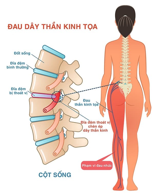 Đau dây thần kinh tọa là bệnh gì?