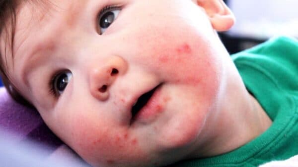 Nhận biết dấu hiệu bị tay chân miệng ở trẻ em-1