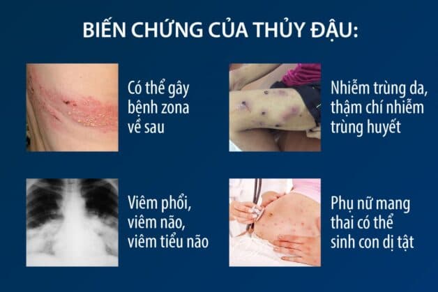 Dấu hiệu của thủy đậu