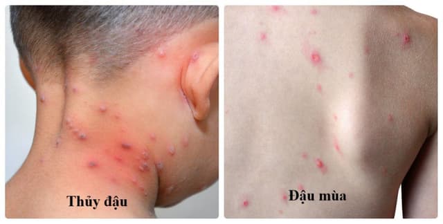 Đậu mùa và thủy đậu là 2 bệnh khác nhau chớ nhầm lẫn