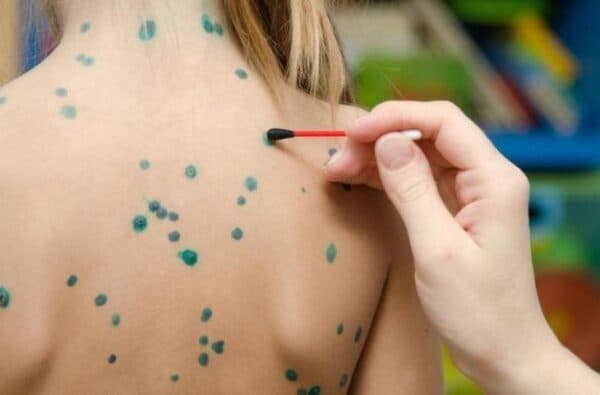 Thủy đậu và đậu mùa là 2 bệnh khác nhau chớ nhầm lẫn-3