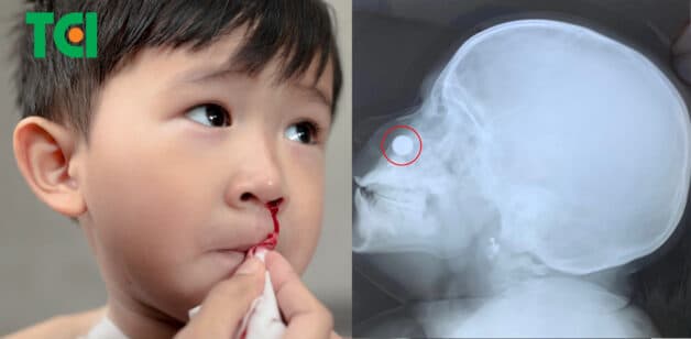 Dị vật đường mũi có thể gây nhiều nguy hiểm