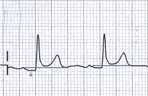Điện tâm đồ là gì? Điện tâm đồ ECG được sử dụng trong chẩn đoán và theo dõi nhiều bệnh lý tim mạch