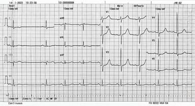 Giải đáp điện tâm đồ là gì, đối tượng, mục đích sử dụng