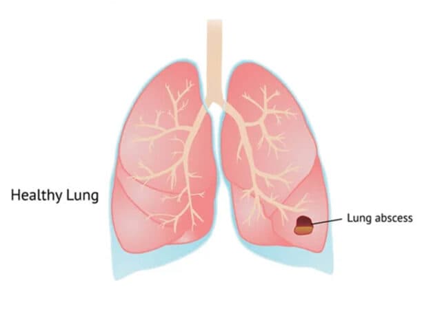 Điều trị áp xe phổi cần được diễn ra càng sớm càng tốt