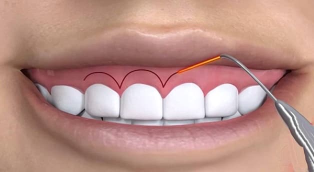 điều trị cười hở lợi bao nhiêu tiền