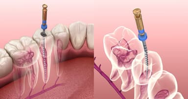 Điều trị viêm tủy răng bao nhiêu tiền và quy trình thực hiện