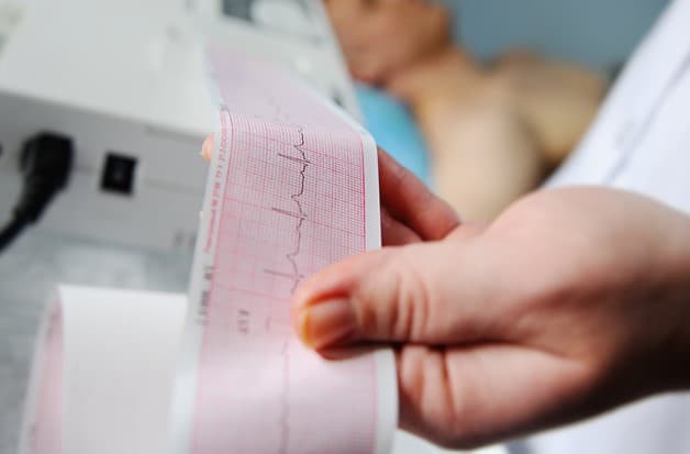 Đo điện tâm đồ trong phát hiện hở van tim ba lá