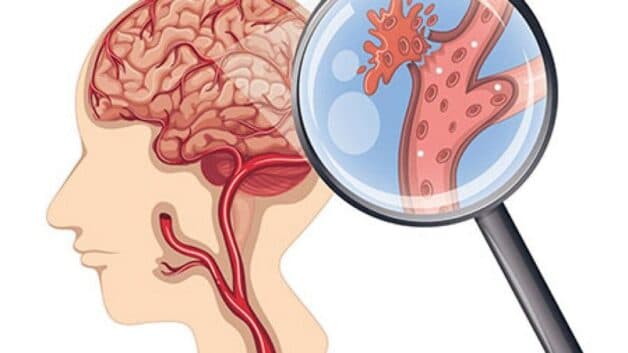 Nguyên nhân gây động kinh là từng bị đột quỵ trước đó