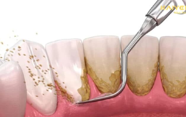 Bộ dụng cụ lấy cao răng
