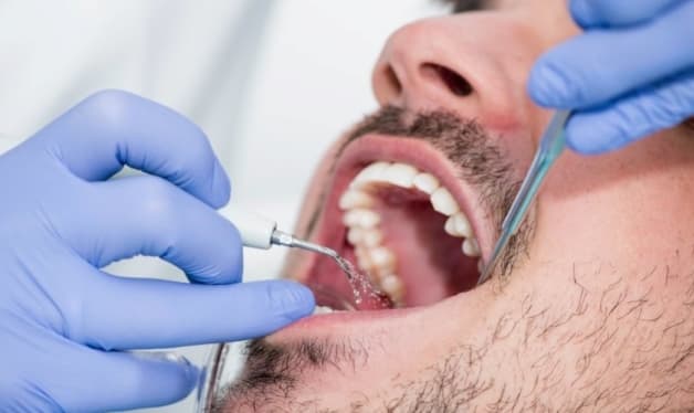 Lấy cao răng bằng dụng cụ tự lấy cao răng