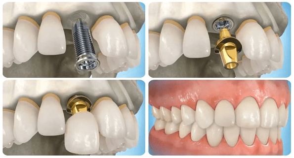 Có nhiều kiểu trồng răng Implant