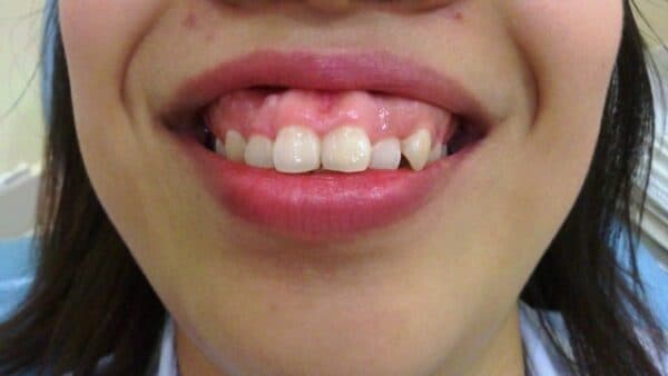 giá điều trị cười hở lợi