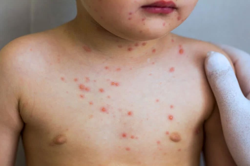Bệnh Rubella gây ra triệu chứng phát ban trên cơ thể