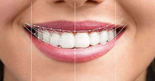 Giá phẫu thuật cười hở lợi và những điều cần biết