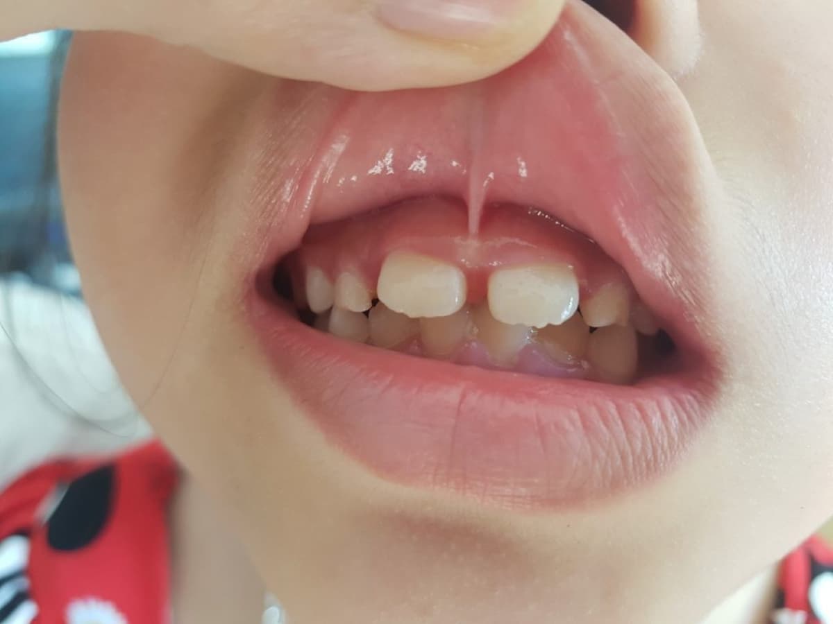 Những vấn đề liên quan đến hàn khe răng thưa