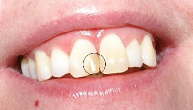 Có nhiều chất liệu hàn răng đẻ người bệnh lựa chọn