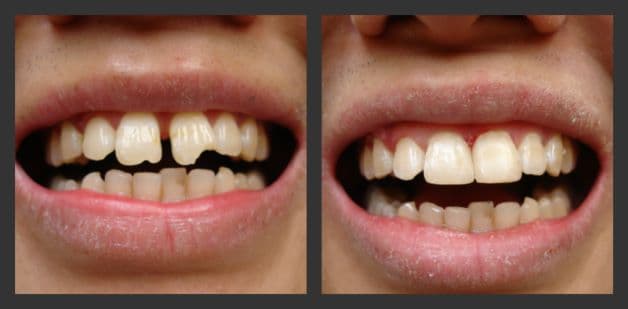 hàn răng cửa thưa trước sau