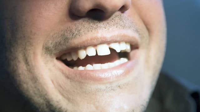 Yếu tố quyết định hàn răng mẻ hết bao nhiêu tiền