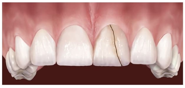 hàn răng sứ bị mẻ