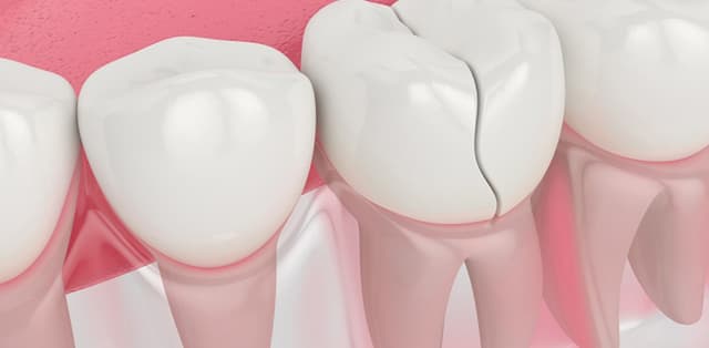 Hàn răng tạm thời – Những công dụng không thể bỏ qua