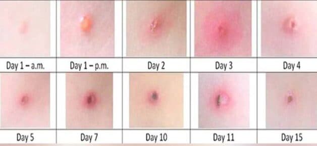 hình ảnh bệnh thủy đậu theo thời gian
