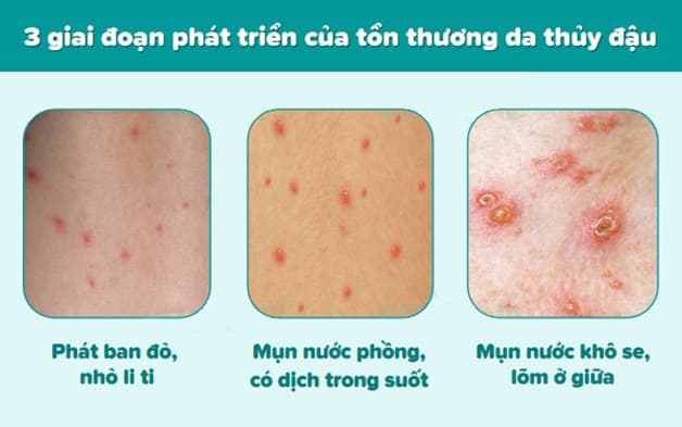 hình ảnh các giai đoạn bệnh thủy đậu