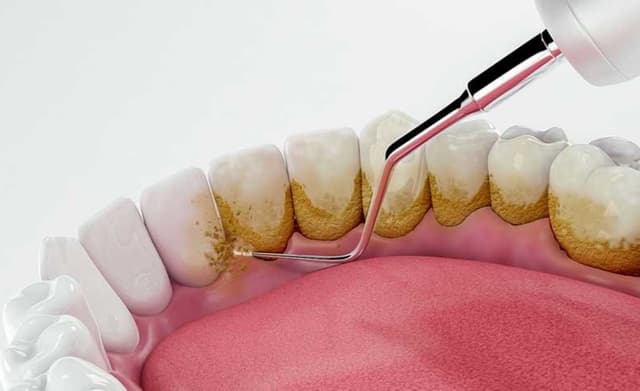 Hình ảnh vôi răng báo hiệu sức khỏe răng miệng