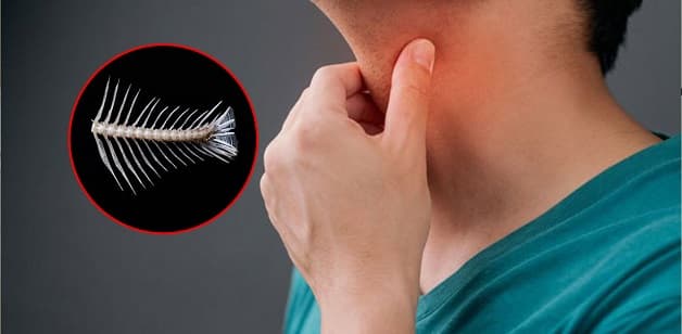 trả lời hóc xương cá uống thuốc gì