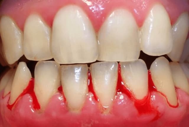 Những thông tin về vấn đề hôi miệng chảy máu chân răng