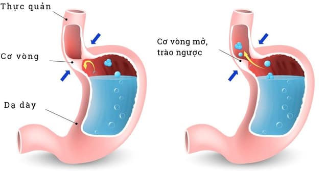 Hôi miệng hở van dạ dày: Nguyên nhân và cách khắc phục