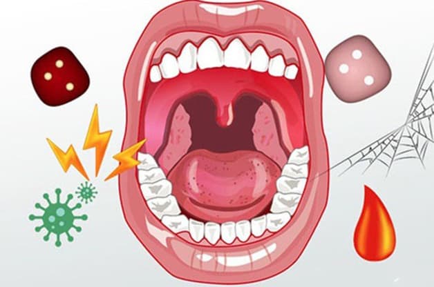 Hôi miệng hơi thở có mùi là gì?