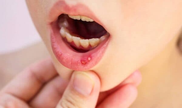 Tình trạng nhiệt miệng hôi miệng ở trẻ nhỏ là như thế nào?