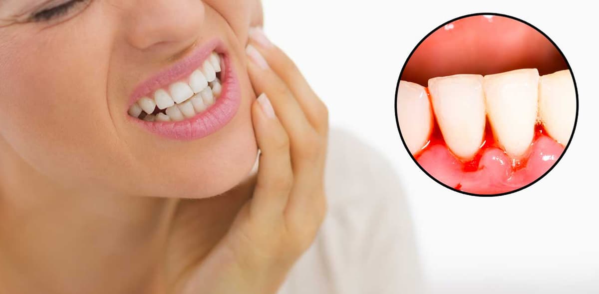 Cảnh báo hiện tượng hôi miệng và chảy máu chân răng