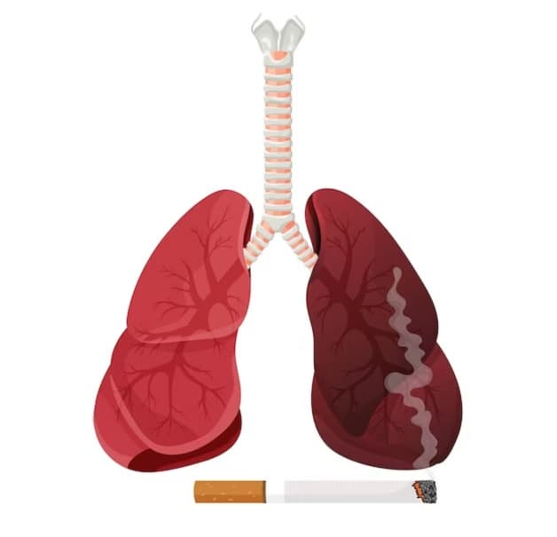 Nguyên nhân dẫn đến bệnh phổi tắc nghẽn mạn tính - COPD