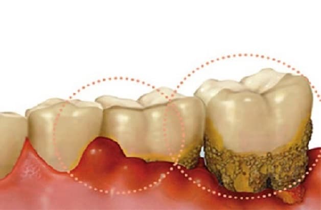 Tìm Kem đánh răng đánh bay cao răng