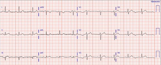 Đo điện tâm đồ là gì?