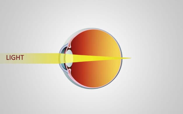 Viễn thị hay Hyperopia/Hypermetropia/Farsightedness trong tiếng Anh là tật khúc xạ khiến người bệnh gặp khó khăn khi nhìn gần, mặc dù nhìn xa thì không.