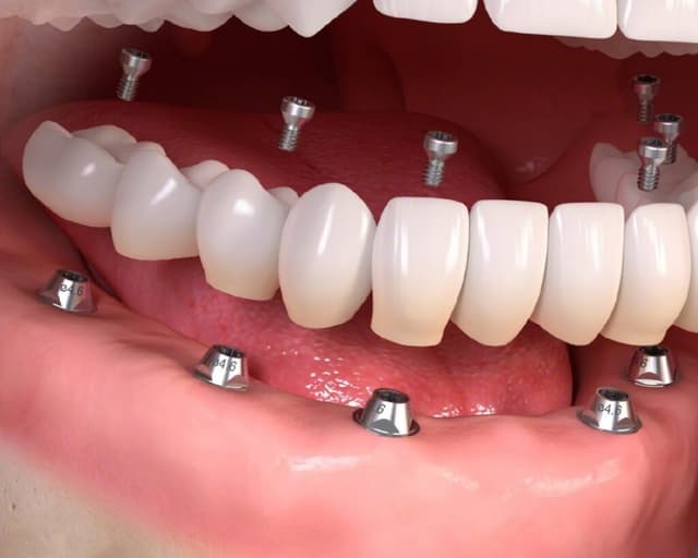 Kỹ thuật trồng răng implant và thông tin có thể bạn chưa biết